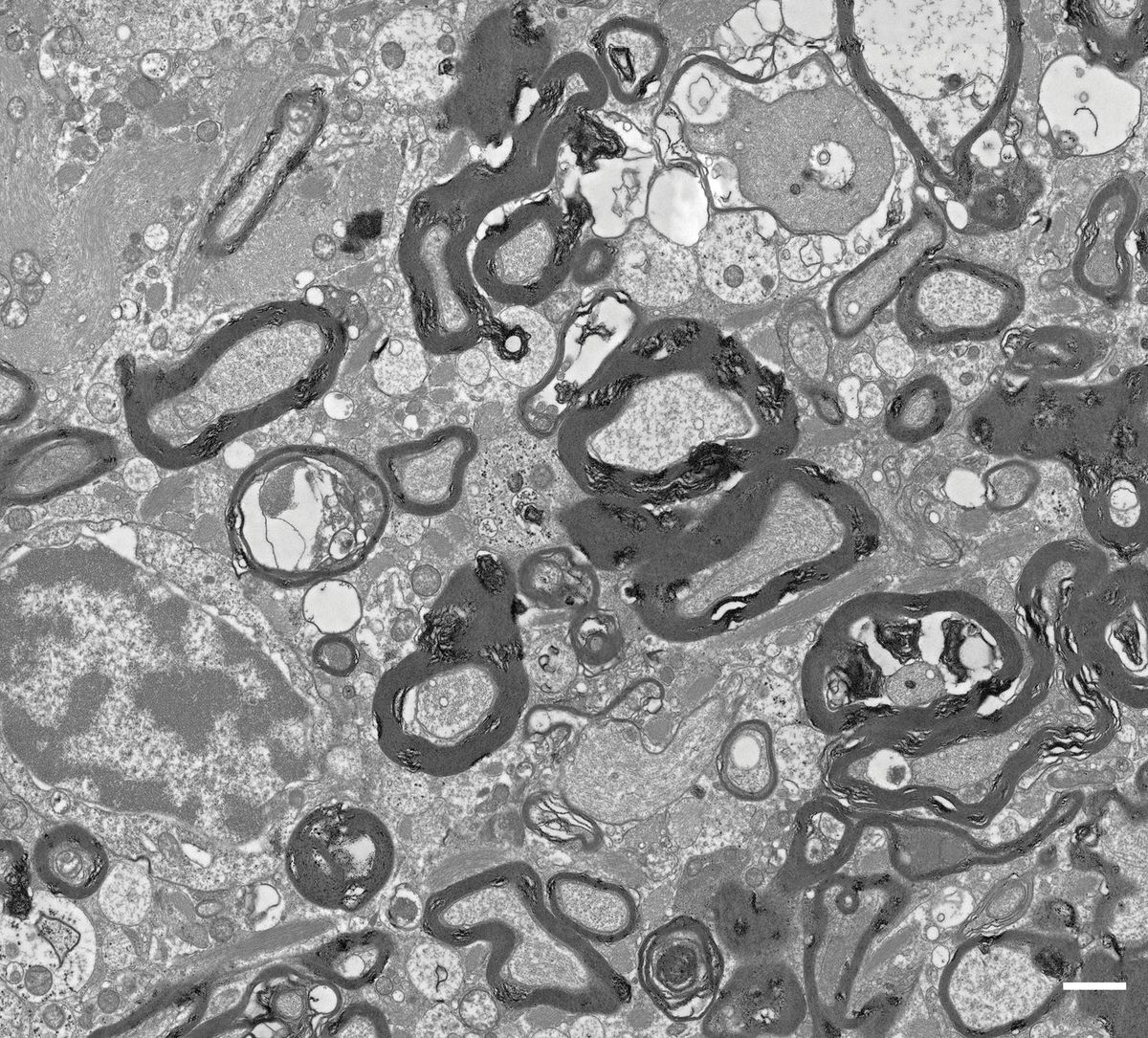 Electron microscopy shows myelin overgrowth around axons in the white matter of a patient with ALSP.