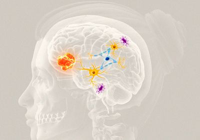 An illustration of an orange tumor in a brain forming connections to healthy yellow neurons.