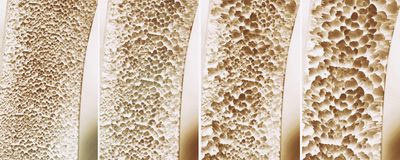 The image shows four different bones with varying degrees of osteoporosis.