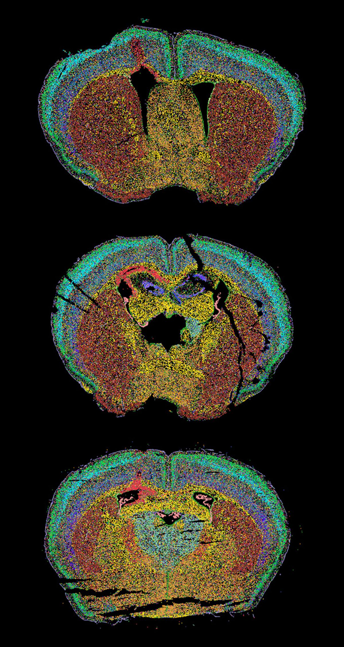 A global map of a mouse brain made with spatial transcriptomics-correlated electron microscopy (STcEM). The map depicts areas of demyelinating injury, specifically in bright red at the top left where a congregation of microglia cells accumulate at the lesion site. Nearby colors indicate other cell types such as oligodendrocytes (yellow), astrocytes (green), and vascular cells (violet), which all play intricate roles in the ailing brain.